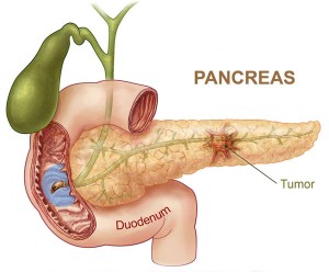 Лечение рака поджелудочной железы в Израиле